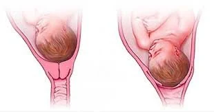 Imagen de referencia de cervicometría publicada en la web de Natal Médica
