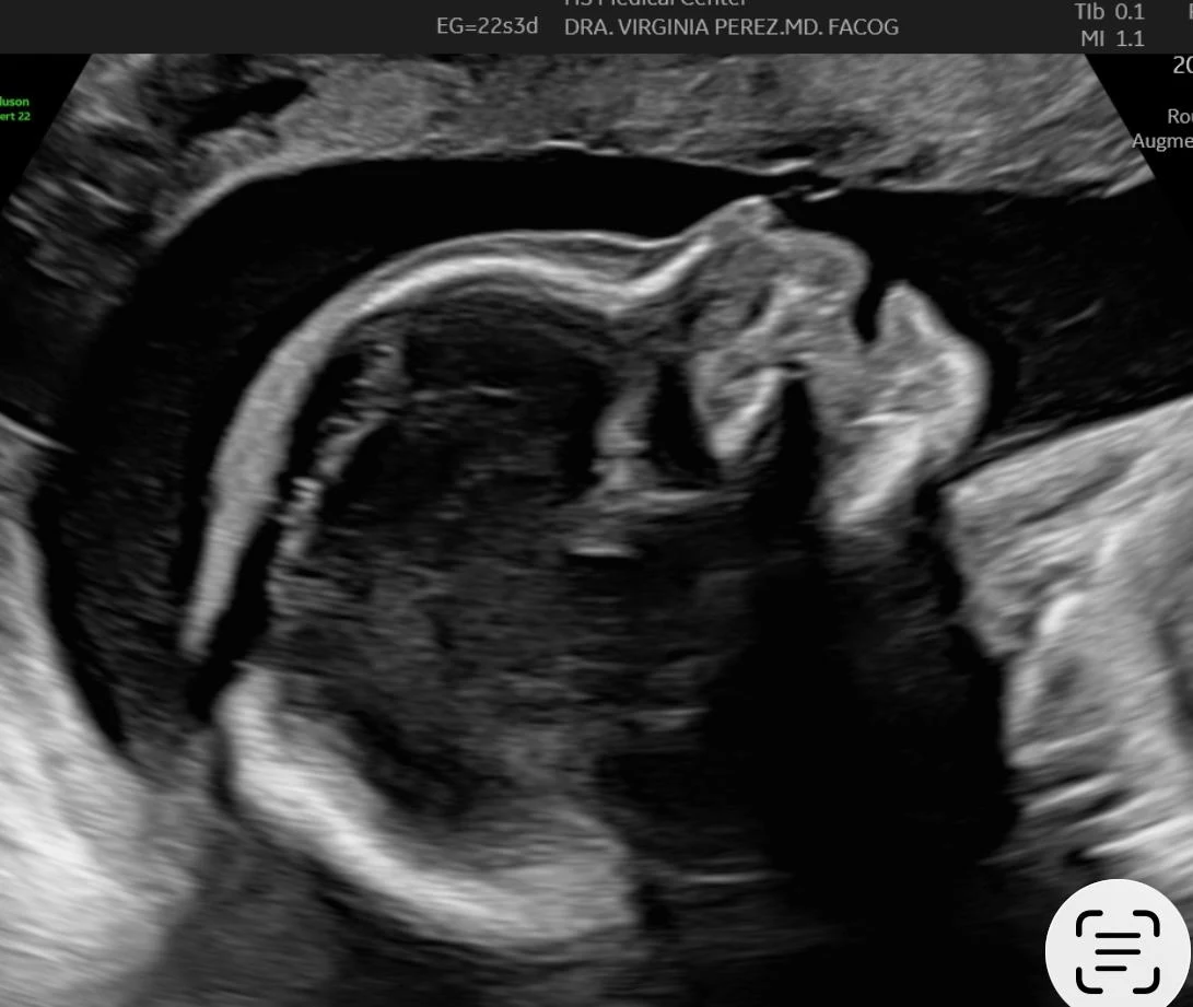 Sonografía genética realizada en Natal Médica