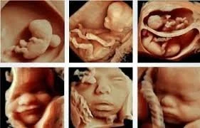 Imagen de referencia de sonografía morfológica publicada en la web de Natal Médica