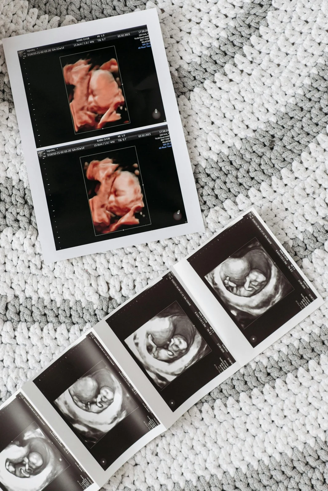 Imágenes impresas de sonografía obstétrica